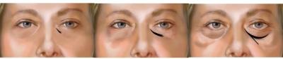 China a solução composta ácida hialurónica injetável de 1ml 2ml remove o tratamento escuro dos círculos dos olhos à venda
