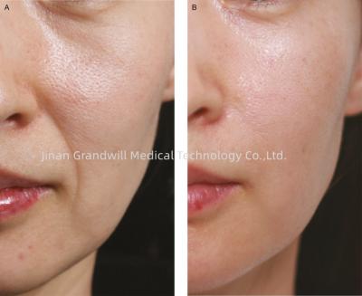 China PCL Cross Linked Hyaluronic Acid Dermal Filler Polycaprolactone for sale