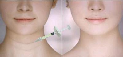 China Obtener labios más largos con rellenos de labios dérmicos Líneas del cuello Rellenos de arrugas de la cara Rellenos en venta