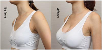China Hyaluronic Acid Breast Injection Filler Breast Sodium Hyaluronate Enhancement Gel for sale