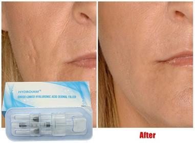 China Hyaluronic Acid Injectable Filler 10ml For Lip Injection Cheeks Chin Augmentation for sale