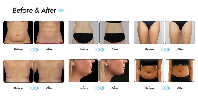 cryolipolysis fat freezing machine cryolipolysis fat freezing machine