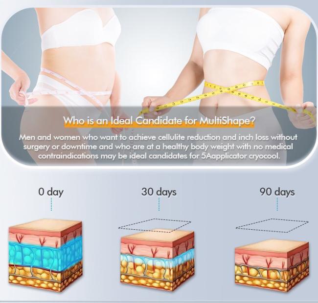best at home cryolipolysis machine best at home cryolipolysis machine