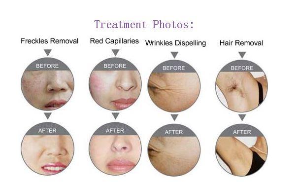 Ipl Shr Elight Machine For Hair Removal And Skin Rejuvenation Ipl Shr Elight Machine For Hair Removal And Skin Rejuvenation