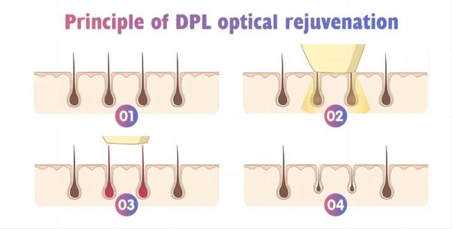 Dpl IPL Laser Hair Removal Equipment Cost High Quality Commercial Use OEM Aesthetics Painless Hair Removal Dpl IPL Laser Hair Removal Equipment Cost High Quality Commercial Use OEM Aesthetics Painless Hair Removal1