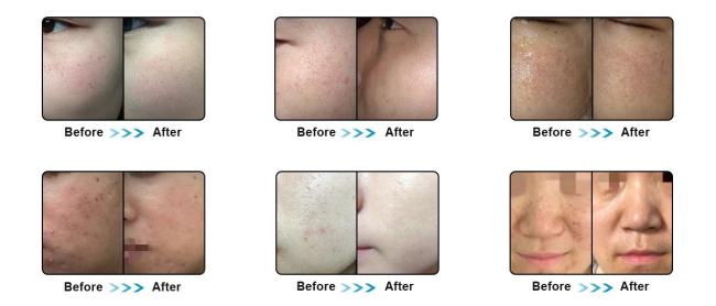 Multi-function Hair Removal Skin Rejuvenation Machine DPL Multi-function Hair Removal Skin Rejuvenation Machine DPL