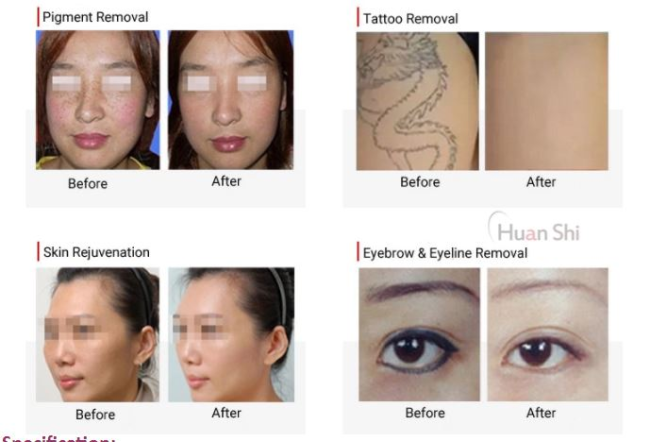 Picosecond Tattoo Removal Pigment Removal 1064nm 532nm 755nm Pico Laser Picosecond Tattoo Removal Pigment Removal 1064nm 532nm 755nm Pico Laser