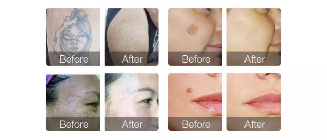 picosecond tattoo removal laser picosecond tattoo removal laser