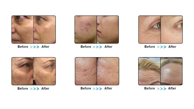 face lift skin tighten machine face lift skin tighten machine