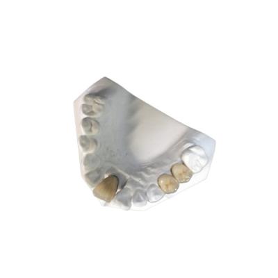中国 安定性が高い陶磁器の歯科PFMの王冠の自然な歯は抵抗力がある汚れる 販売のため