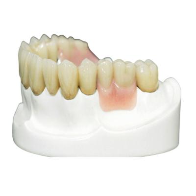 China MK1 Precision Attachment Denture for Perfect Fit and Protection for sale
