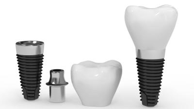 China Barra natural do implante dental da vida útil longa artificial segura segura do implante da raiz à venda