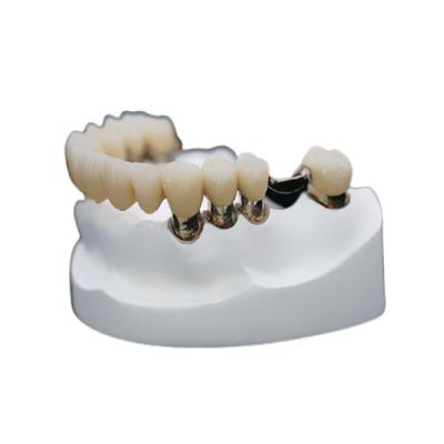 China Corrosion Resistance Dental Telescopic Crown Precision Attachment Denture Strong Stability for sale