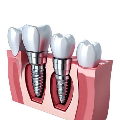 China Embracing Technological Advancements The Future Of Dental Implant Crowns for sale