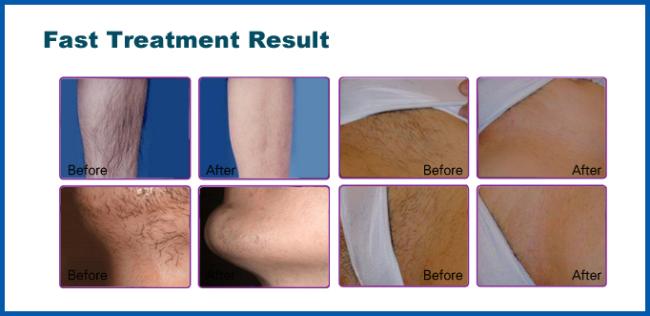 Christmas promotion price ! Germany 10 Bars Micro-channel 808nm diode laser hair removal machine price /diode laser machine