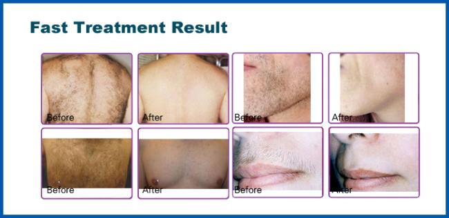 Christmas promotion price ! Germany 10 Bars Micro-channel 808nm diode laser hair removal machine price /diode laser machine