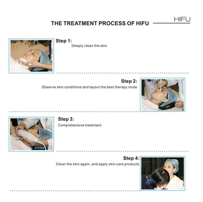 New Year Sale!! Staionary Facial Wrinkle/Freckle/Acne Removed System HIFU Lifting Machine