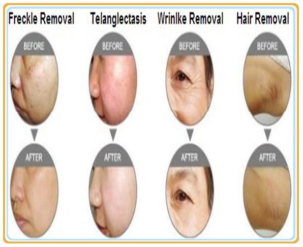 2015 Hot Sell !! Spa SHR IPL Laser Hair Removal Machine For Sale SHR IPL Elight RF Hair Removal