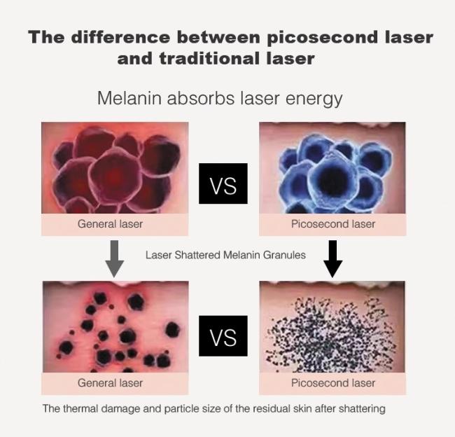 S.Korea Pico Care Laser Machine Q Switched Picosecond ND Yag for Skin Tattoo Removal 1064 532 755 nm Pigment Laser