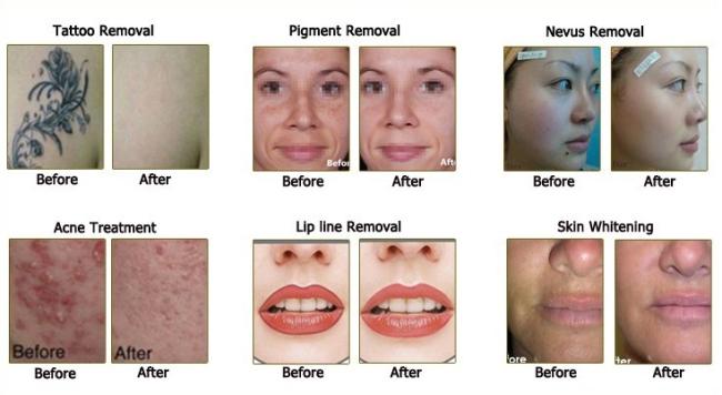 S.Korea Pico Care Laser Machine Q Switched Picosecond ND Yag for Skin Tattoo Removal 1064 532 755 nm Pigment Laser