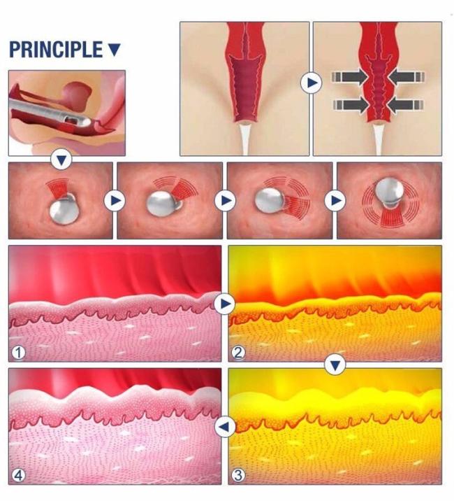 Beauty scar removal co2 laser vagina tightening product wrinkle removal co2 laser vagina tightening