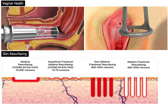 Beauty scar removal co2 laser vagina tightening product wrinkle removal co2 laser vagina tightening