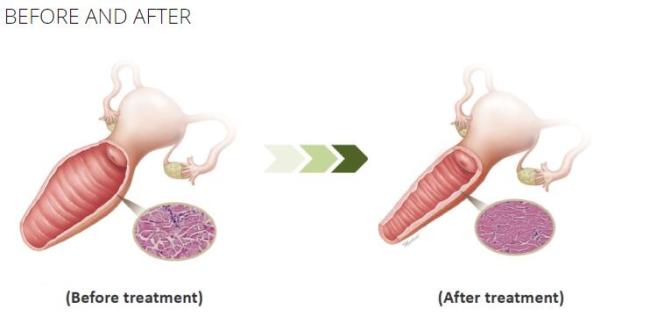 Beauty scar removal co2 laser vagina tightening product wrinkle removal co2 laser vagina tightening