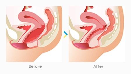 Professional women Intensity Vagina Tightening Equipment Painless HIFU vagina tightening