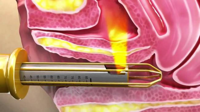 Professional women Intensity Vagina Tightening Equipment Painless HIFU vagina tightening