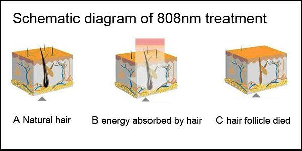 hot 808nm diode hair removal alma harmony laser