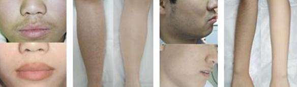 1HZ - 10HZ Permanent Diode Laser Hair Removal With Water Cooling System