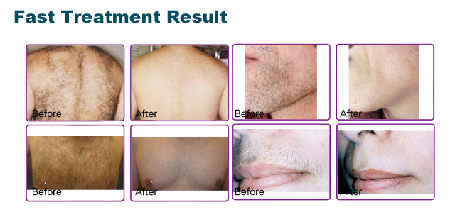 Promotion price SHR Elight hair removal beauty machine MB600C