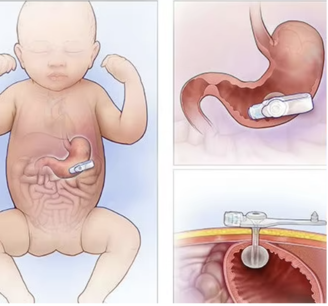 Mini Gastric Tube Balloon Insert Device - close-up detail
