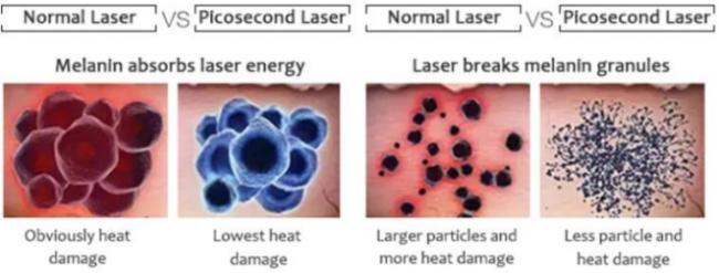 1064nm 2-10mm continuously adjustable Spot Pigmentation eraser Removal Picosecond Laser Machine 4