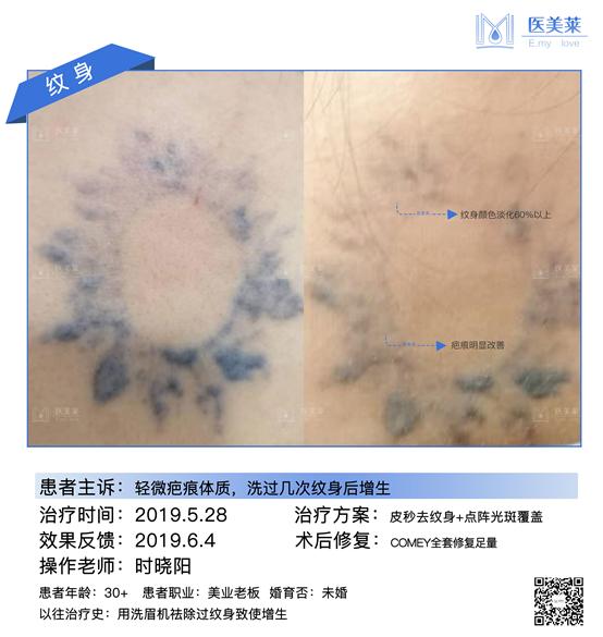 1064nm 2-10mm continuously adjustable Spot Pigmentation eraser Removal Picosecond Laser Machine 9