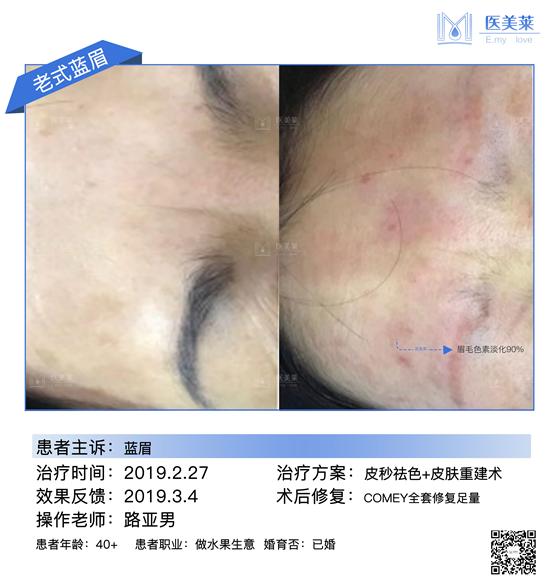 1064nm 2-10mm continuously adjustable Spot Pigmentation eraser Removal Picosecond Laser Machine 10