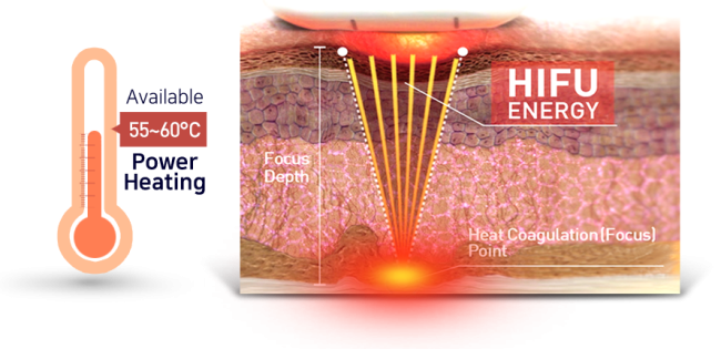 hifu hironic