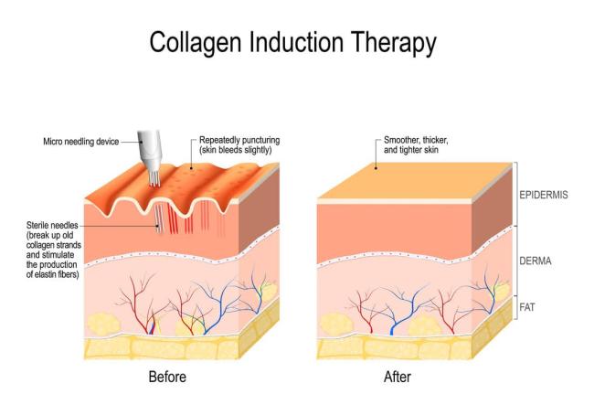 Microneedling - DermaGlam Clinic