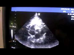 Mindray 2P2 Phased array ultrasound transducer probe for Cardiac / Pediatric