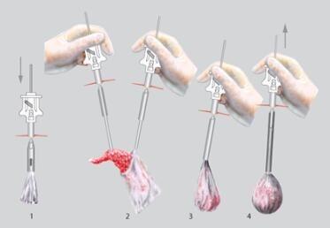 China Recuperación Laparoscopic del espécimen de la cirugía 10m m Endobag en venta