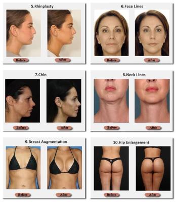 中国 Skinjection 10 Ml And 20 Ml Hyaluronic Breast Filler Korean Technnology 24 Mg/Ml 販売のため