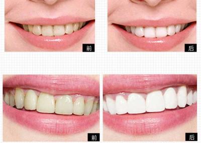 Chine Système privé de blanchiment de dent de produits de soin personnel de logo pour les dents à la maison blanchissant à vendre