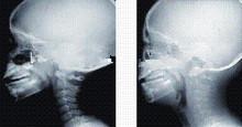 China Alta proyección de imagen de diagnóstico de la cobertura X Ray de la tinta, película médica del rayo de x del laser de 35 de los x 43cm en venta