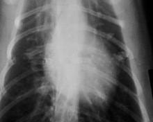 Китай Низкий туман 11 кс бумажный фильм рентгеновского снимка 14 для медицинских лазерных принтеров КНД-К продается