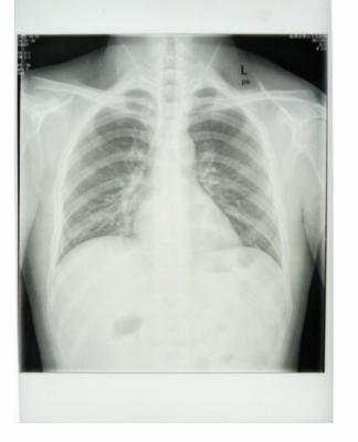 China Custom 25cm * 30cm White Base Xray Paper Medical Film with PET materials for sale