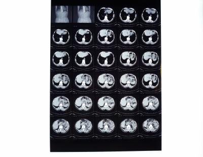 China Filmes médicos do raio de X, filme seco da imagem latente compatível com a impressora térmica para o CT/Dr./MRI à venda