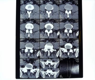 China 8in* 10in filme seco da impressora térmica do raio X médico high-density de 14in * de 17in à venda