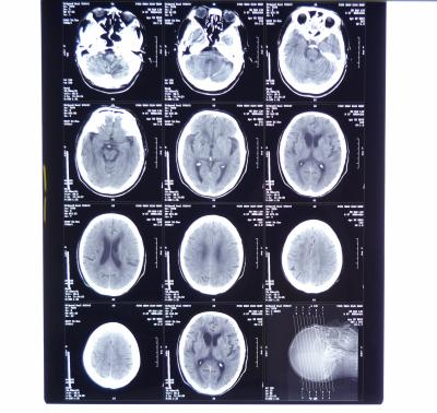 Китай 11ин * медицинское отображение рентгеновского снимка 14ин сухое снимает КНД-А на АГФА 5300, 5302, 5500, 5502, 3000 продается