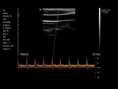 BIO-W4 Linear Scans Carotid Artery PW Mode