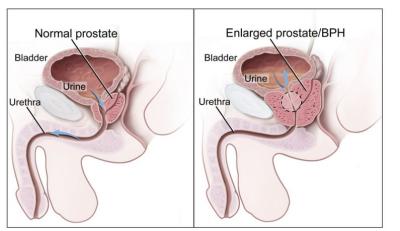 China Dispositivo do tratamento da prostatite/máquina crônicos masculinos da próstata nenhum efeito secundário à venda